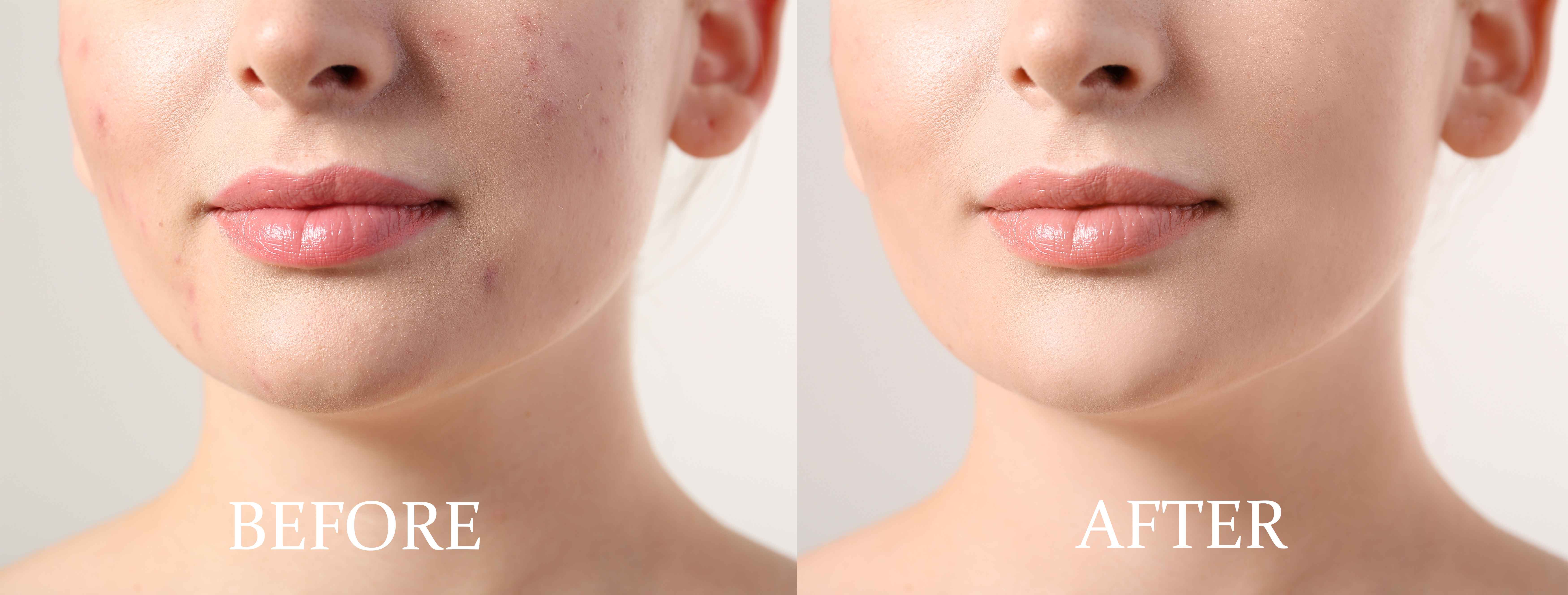 Skin Acne & Blemishes – Prédiré Paris