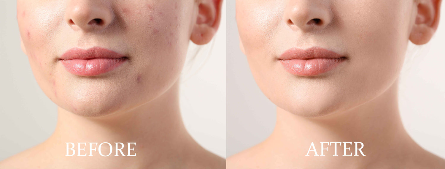 Skin Acne & Blemishes